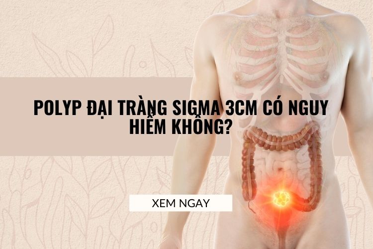 Polyp đại tràng sigma nằm ở đoạn cuối ống tiêu hóa
